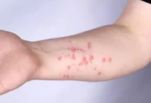 OMS alerta para nova variante da mpox; antiviral mais usado não mostra eficácia