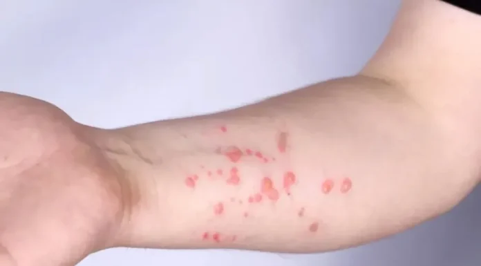 OMS alerta para nova variante da mpox; antiviral mais usado não mostra eficácia