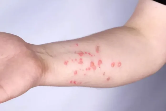 oms-alerta-para-nova-variante-da-mpox-antiviral-ma0138276400202603160839-ScaleDownProportional