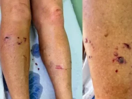 Raposa ataca mulher na Bahia; cidade registra três casos em duas semanas